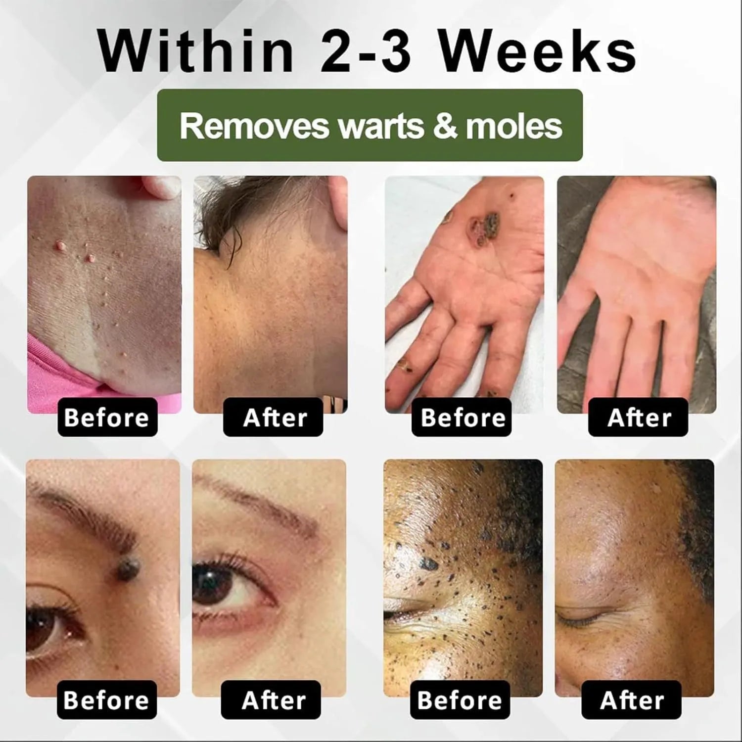 Natureerase mole removal gel tube showing 45g hydrating formula for general skin types