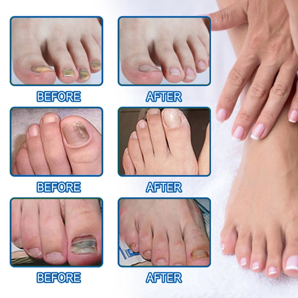 Box of 32 nail repair adhesive bandages with natural ingredients for brittle nails