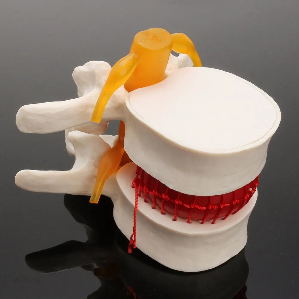 White PVC lumbar intervertebral disc herniation demonstration model showing anatomical detail