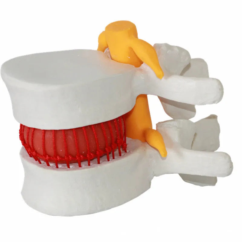 White PVC lumbar intervertebral disc herniation demonstration model showing anatomical detail