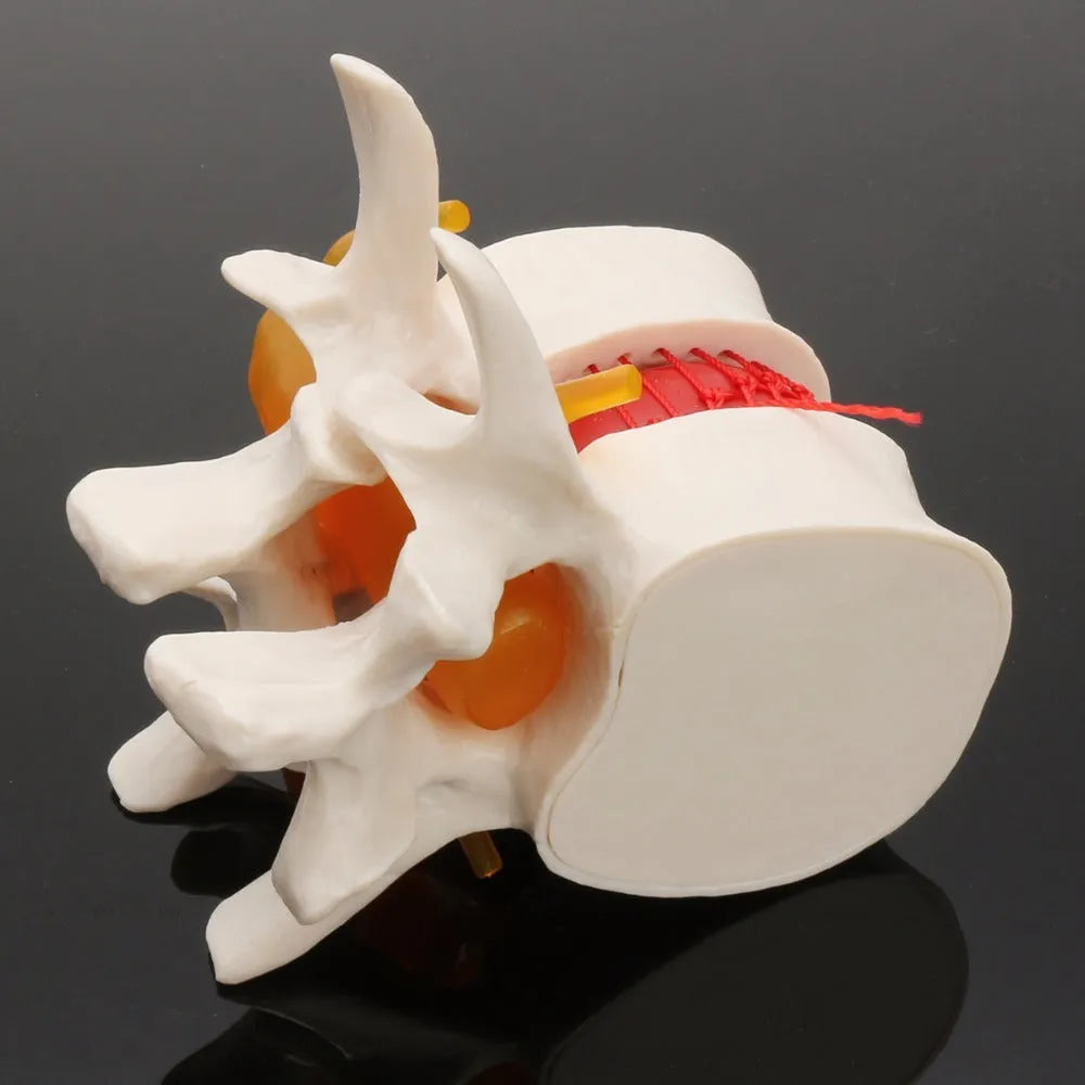 White PVC lumbar intervertebral disc herniation demonstration model showing anatomical detail