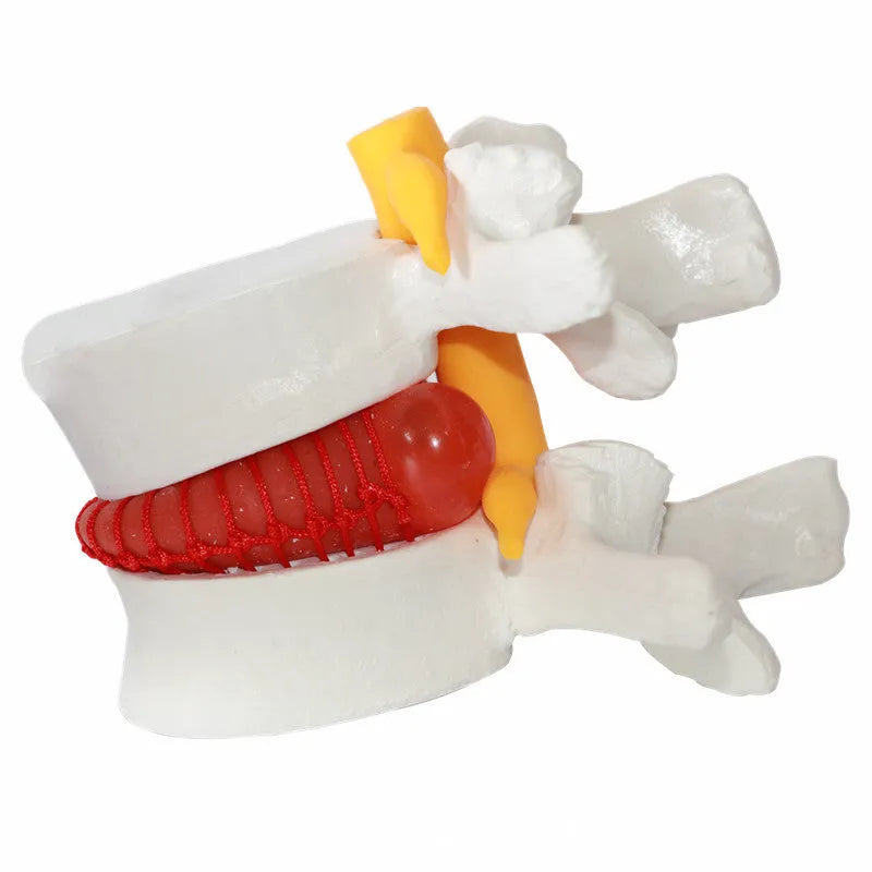 White PVC lumbar intervertebral disc herniation demonstration model showing anatomical detail