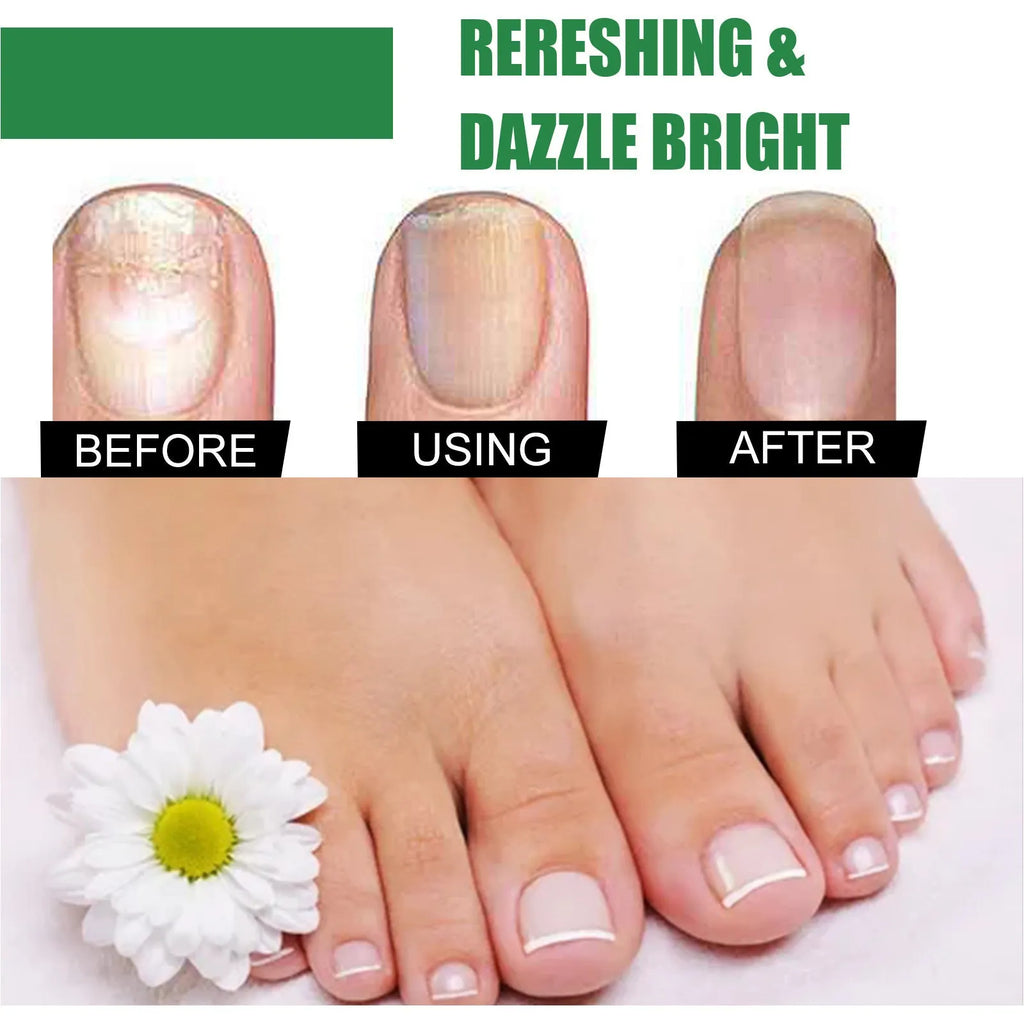 30ml tea tree oil nail repair fluid bottle for thick soft fingernail and toenail treatment