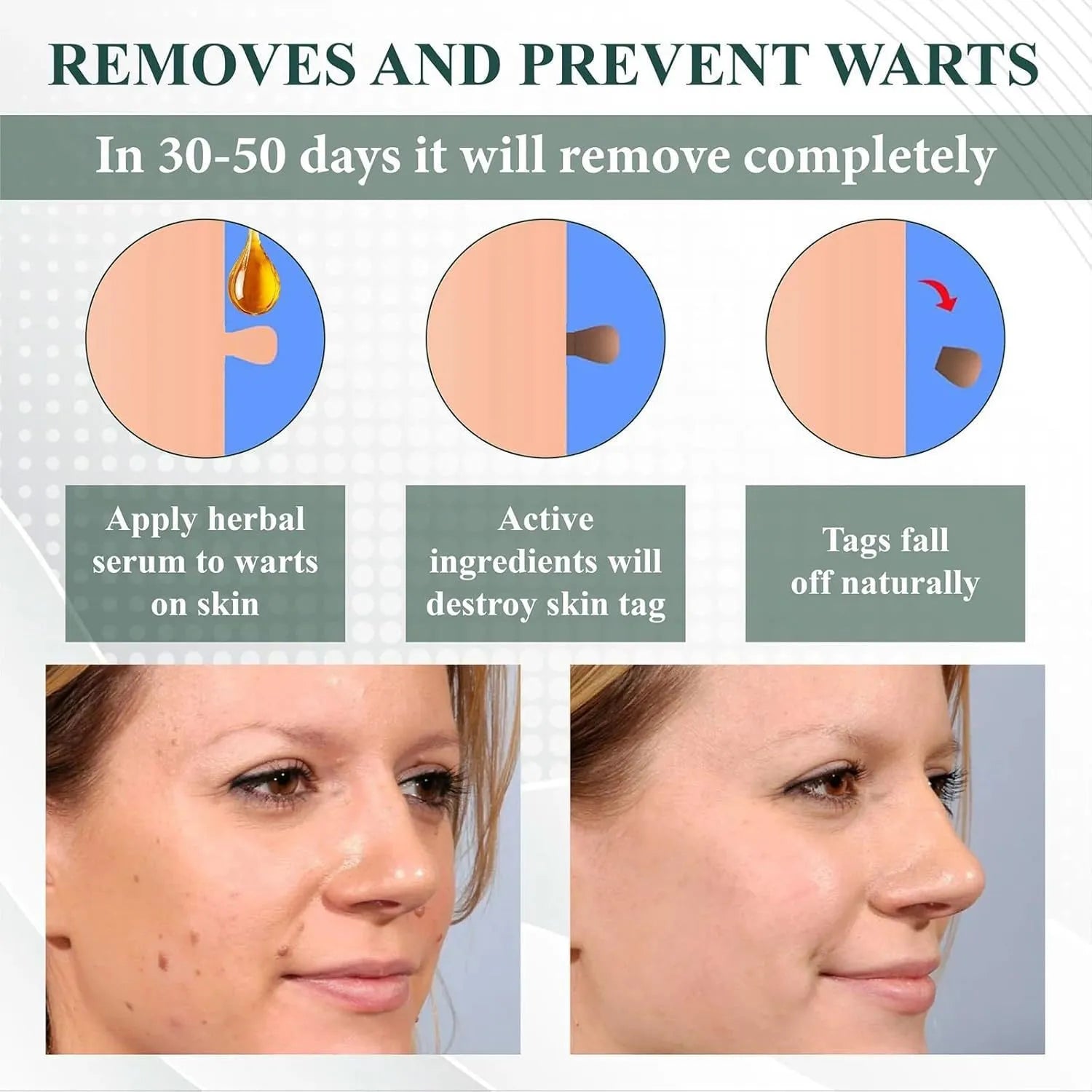 Natureerase mole removal gel tube showing 45g hydrating formula for general skin types