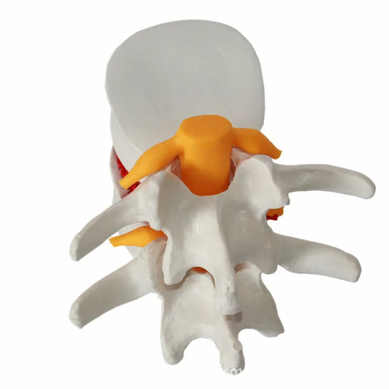 White PVC lumbar intervertebral disc herniation demonstration model showing anatomical detail