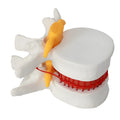 White PVC lumbar intervertebral disc herniation demonstration model showing anatomical detail