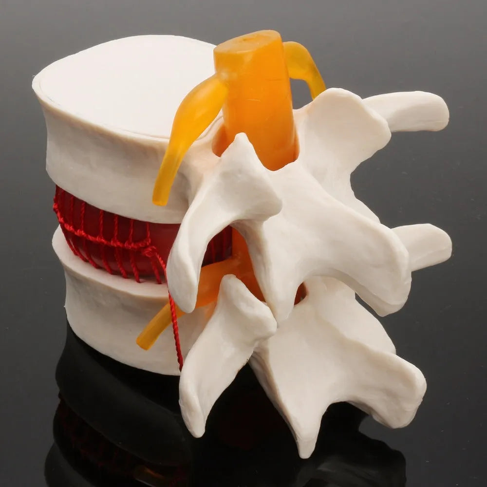 White PVC lumbar intervertebral disc herniation demonstration model showing anatomical detail
