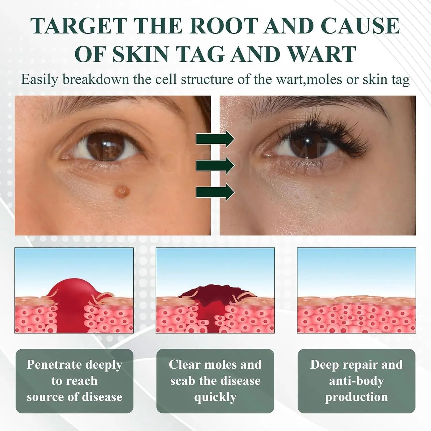 Natureerase mole removal gel tube showing 45g hydrating formula for general skin types