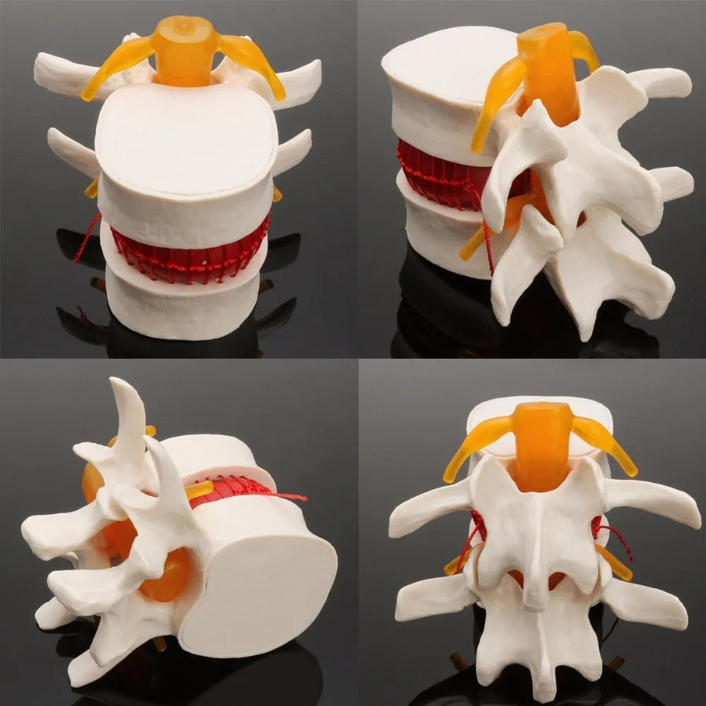 White PVC lumbar intervertebral disc herniation demonstration model showing anatomical detail