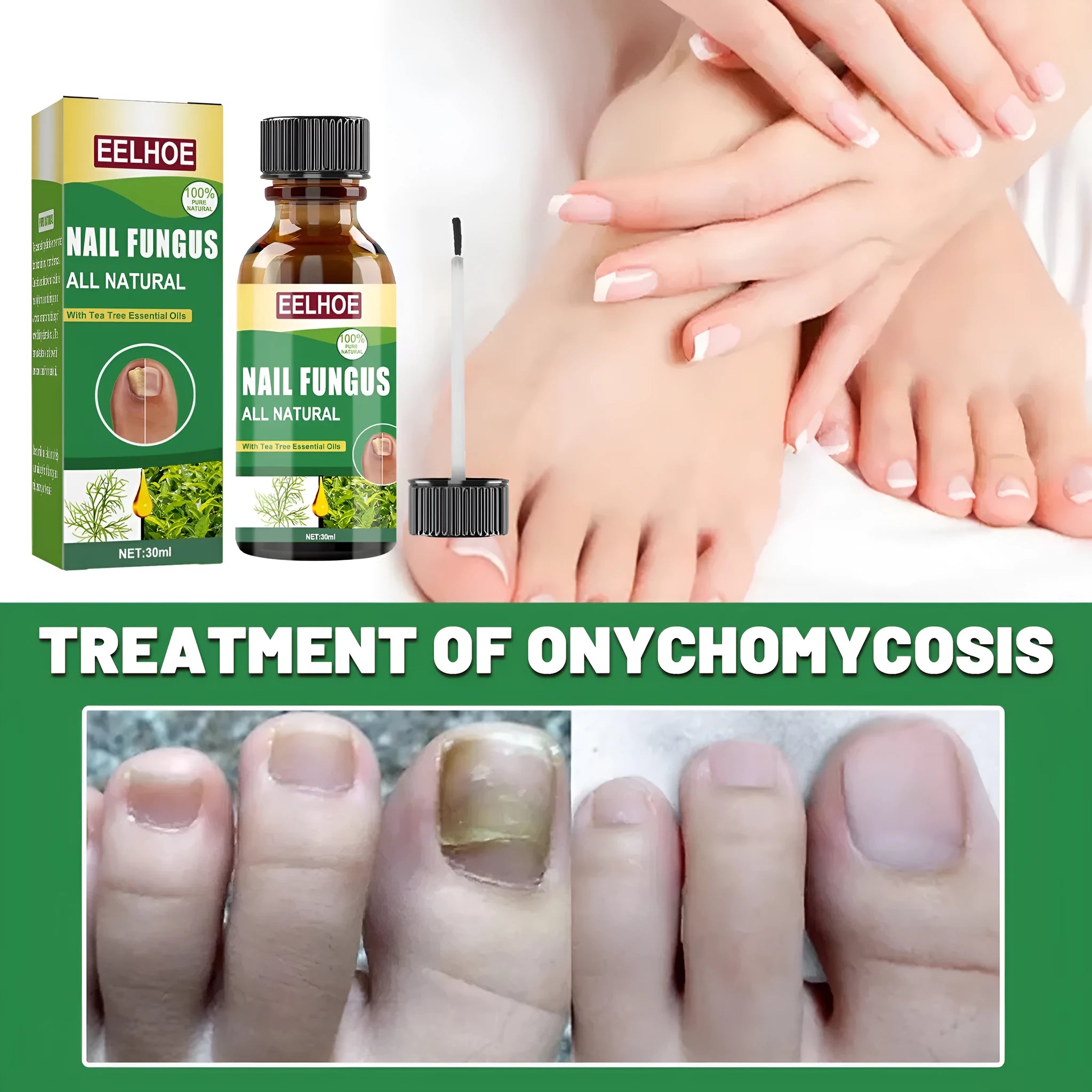 30ml tea tree oil nail repair fluid bottle for thick soft fingernail and toenail treatment